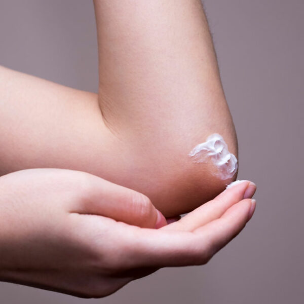 Ringworm – Transmission, Risk factors, and More