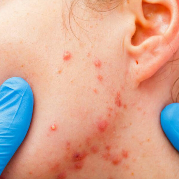 What you need to know about the types and stages of myeloma