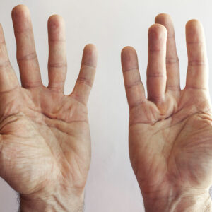 4 hand exercises for Dupuytren’s contracture patients
