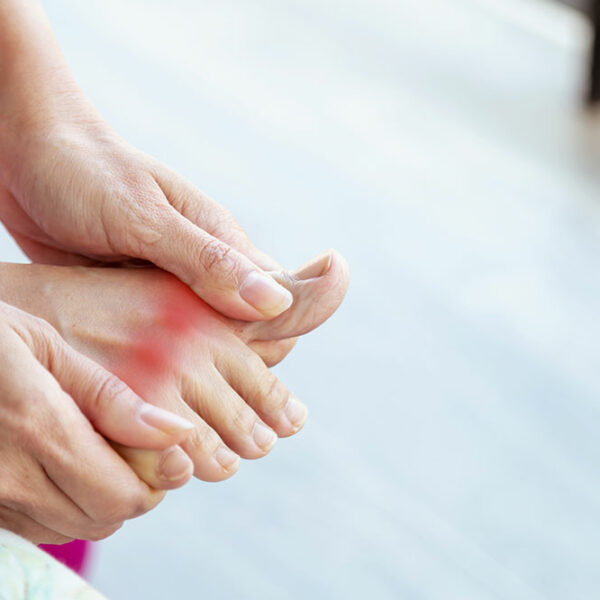 Gout – Diagnosis, stages, and prevention